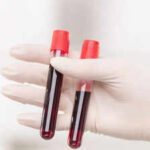 World’s rarest hybrid blood type discovered in Thailand: Study found in just 3 people out of a massive research of 544,000 samples