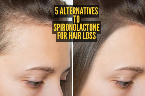 5 alternatives to Spironolactone to reverse hair loss