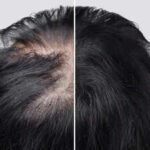 Losing hair because of Alopecia? This Arthritis drug can help you regrow hair like never before