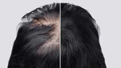 Losing hair because of Alopecia? This Arthritis drug can help you regrow hair like never before