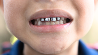 Silver Tooth Kids: Who are ‘silver tooth kids’ and why is the internet calling them ‘bad’?