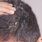 5 hair oils that may be making your dandruff worse