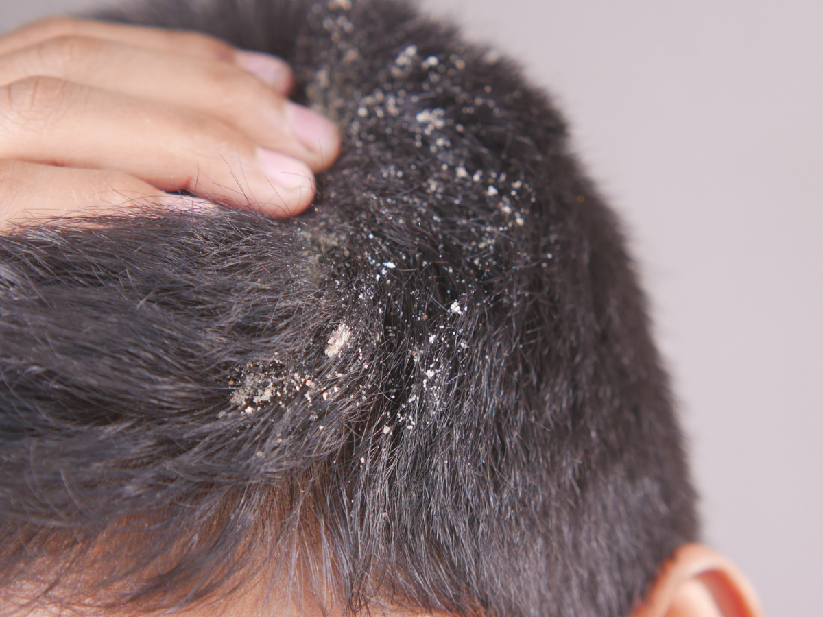 5 hair oils that may be making your dandruff worse
